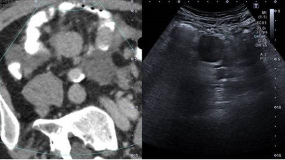 Pathologischer Lymphknoten im Ultraschall 