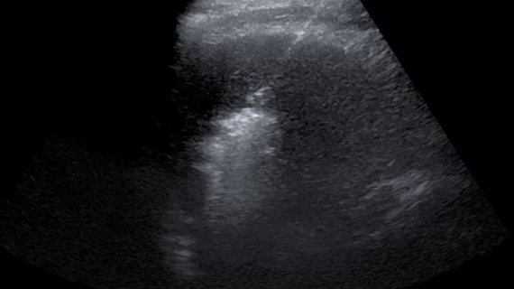 Sonografisch gesteuerte Mikrowellenablation