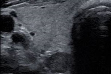 Nebenschilddrüsenadenom dorsal des rechten Schilddrüsenlappens