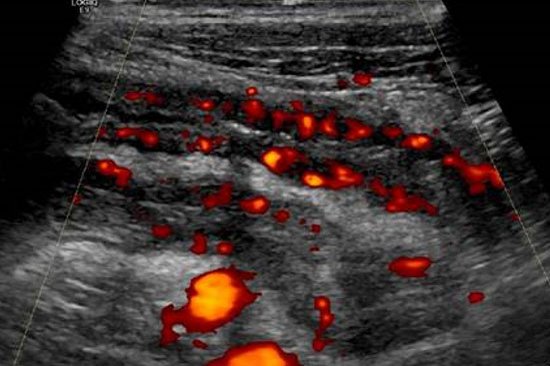 Ileitis terminalis bei M. Crohn