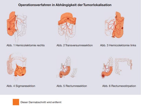 OP-Verfahren in Abhängigheit der Tumorlokasisation