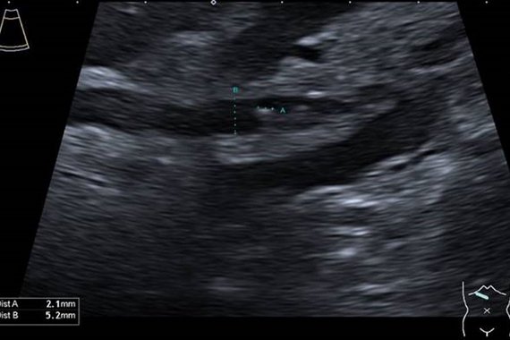 Choledocholithiasis