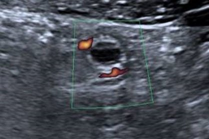 Akute Appendizitis