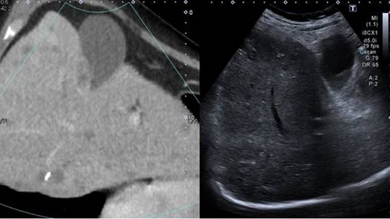 CT-Bild und korrespondierendes Ultraschallbild